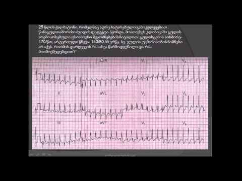 ეკგ / სუპრავენტრიკულური ტაქიკარდია (წინაგულოვანი ტაქიკარდია) / წინაგულთაშორისი ძგიდის დეფექტი